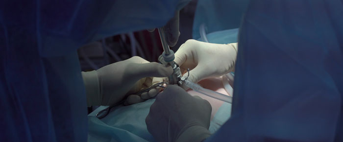 ovariectomia laparoscopica